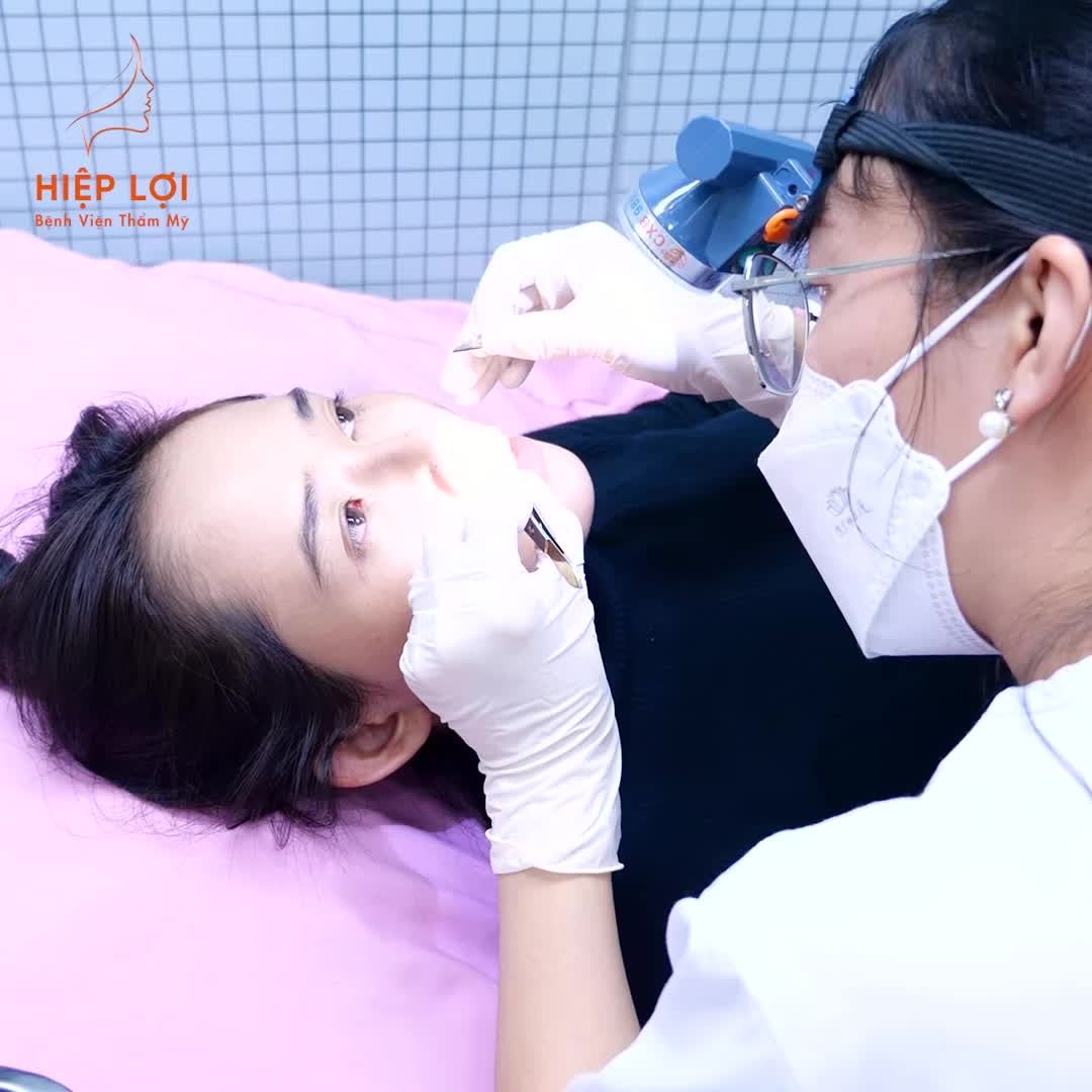 Ca Nâng mũi sụn sườn sau phẫu thuật đạt kết quả như mong muốn hay không còn được quyết định bởi quá trình chăm sóc hậu phẫu và thực hiện đúng lịch tái khám, cắt chỉ.