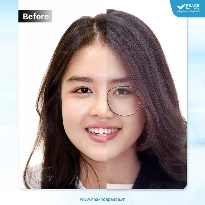 Sau niềng răng, kết quả nhận được sẽ là gì?