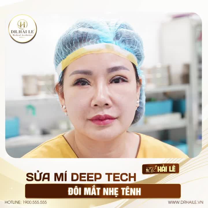 "Say bye" đôi mắt n.ặng n.ề vì đính cơ nâng mi sâu, x.ơ s.ẹo, chỉ sau 1 giờ 30 phút thực hiện sửa mí Deep Tech tại Dr.Hải Lê bạn đã có thể lấy lại "cửa sổ tâm hồn" tự tin.