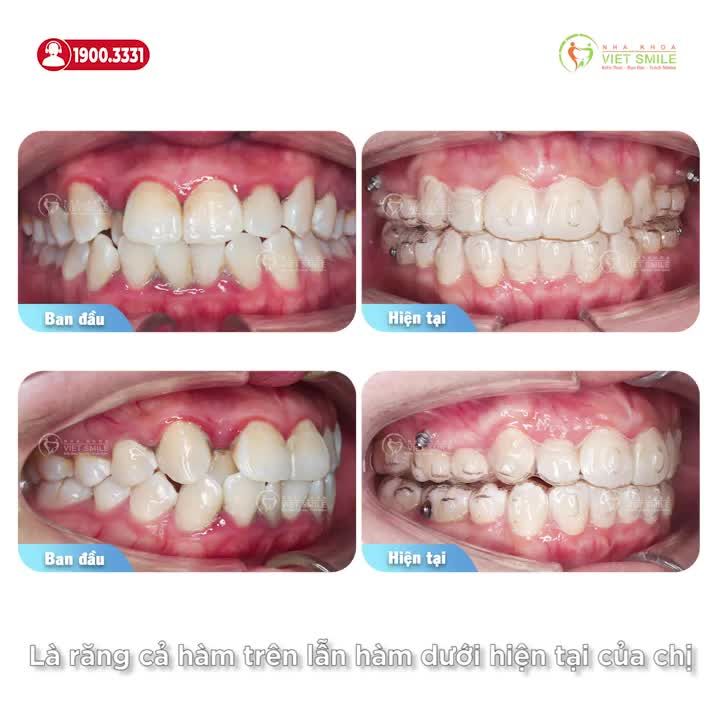 NIỀNG KHAY TRONG SUỐT HẾT CHEN CHÚC, VIÊM LỢI, THẨM MỸ CAO