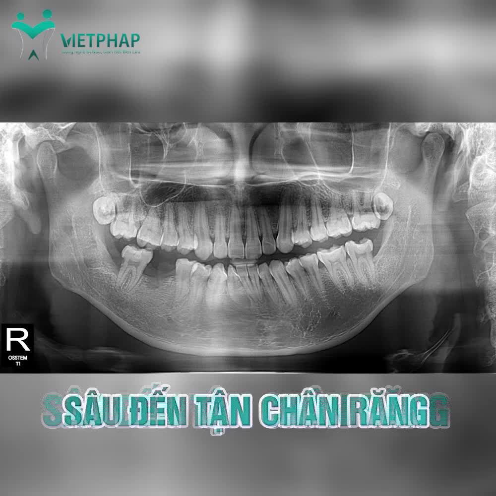 TRỒNG RĂNG IMPLANT CHO KHÁCH HÀNG MẤT RĂNG DO SÂU TẬN CHÂN