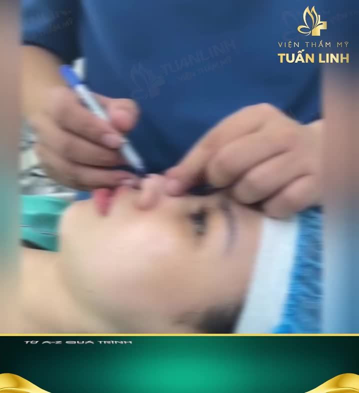 Từ A- Z Quá trình nâng mũi siêu cấu trúc Surgiform tại Tuấn Linh