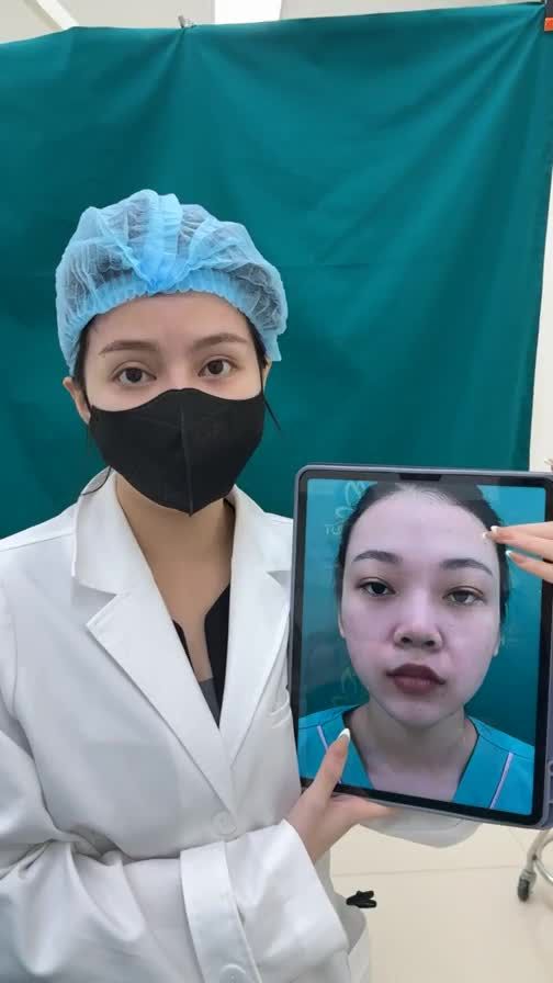 Case mũi cấu trúc sửa lại vừa hoàn thành