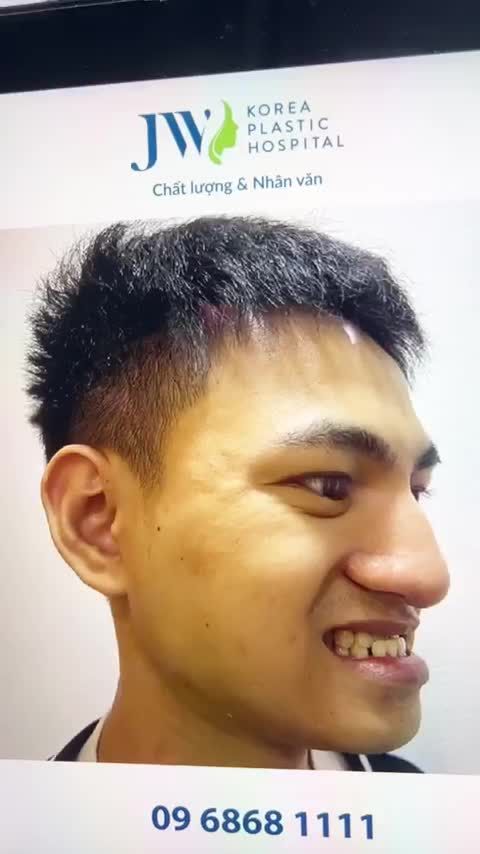 CHIÊM NGƯỠNG kết quả PHẪU THUẬT HÀM MÓM đẹp chuẩn HOTBOY của anh chàng GENZ tại JW