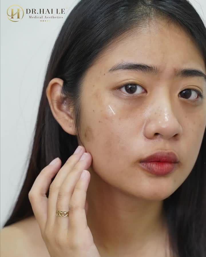 Sắp đến Tết mà làn da vẫn nhiều khuyết điểm. Tốn rất nhiều tiền nhưng cũng không cải thiện được.