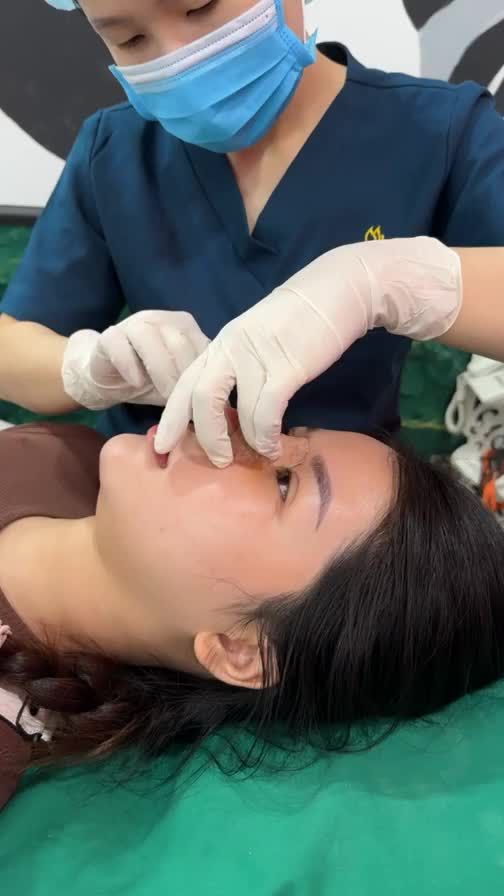 Case mũi bọc sụn 5 ngày