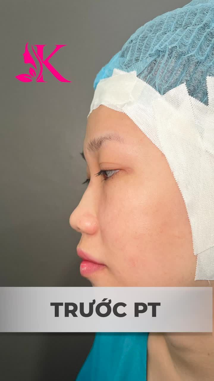 NÂNG MŨI ALINE tại Bác sĩ Kỳ Y Dược sẽ như thế nào?