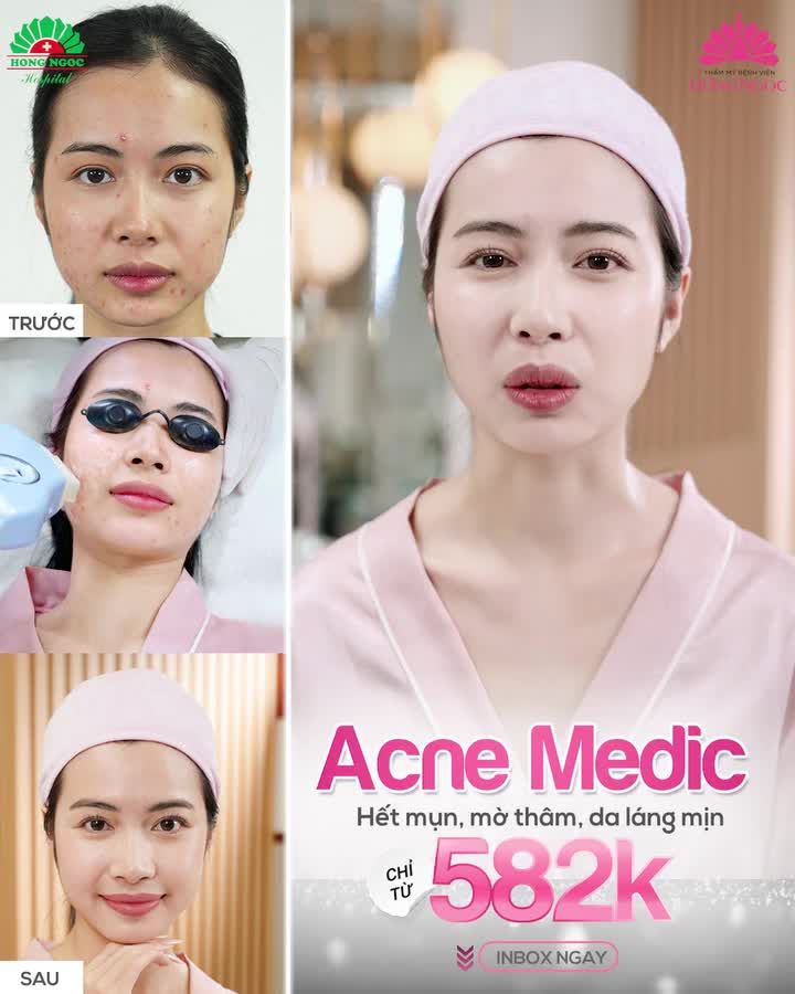 Mụn lên không ngừng do: Vi khuẩn P. Acnes có sẵn trong nang lông gặp điều kiện thuận lợi sinh sôi phát triển và gây viêm