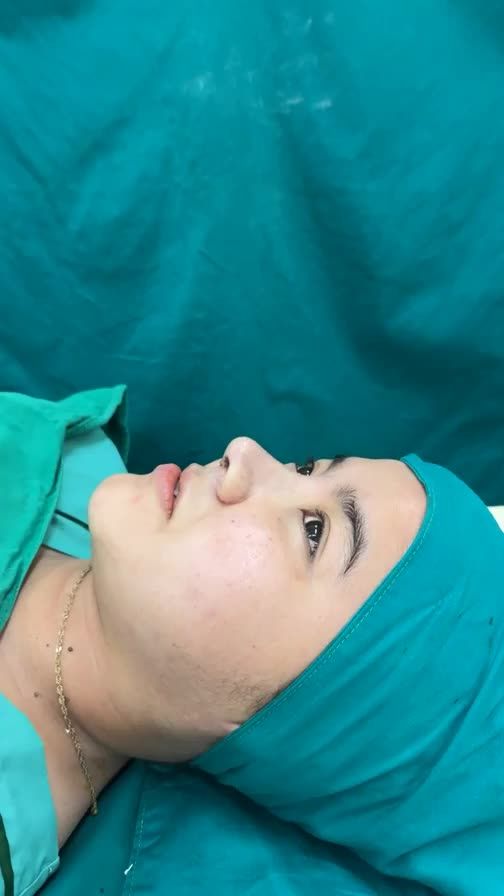 Case mũi cấu trúc surgiform vừa hoàn thành