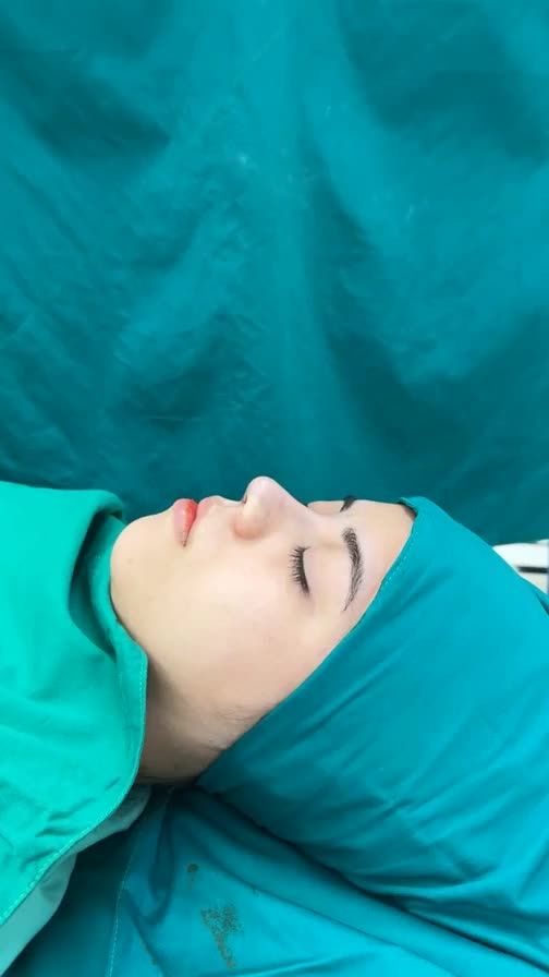 Case mũi cấu trúc vừa hoàn thành