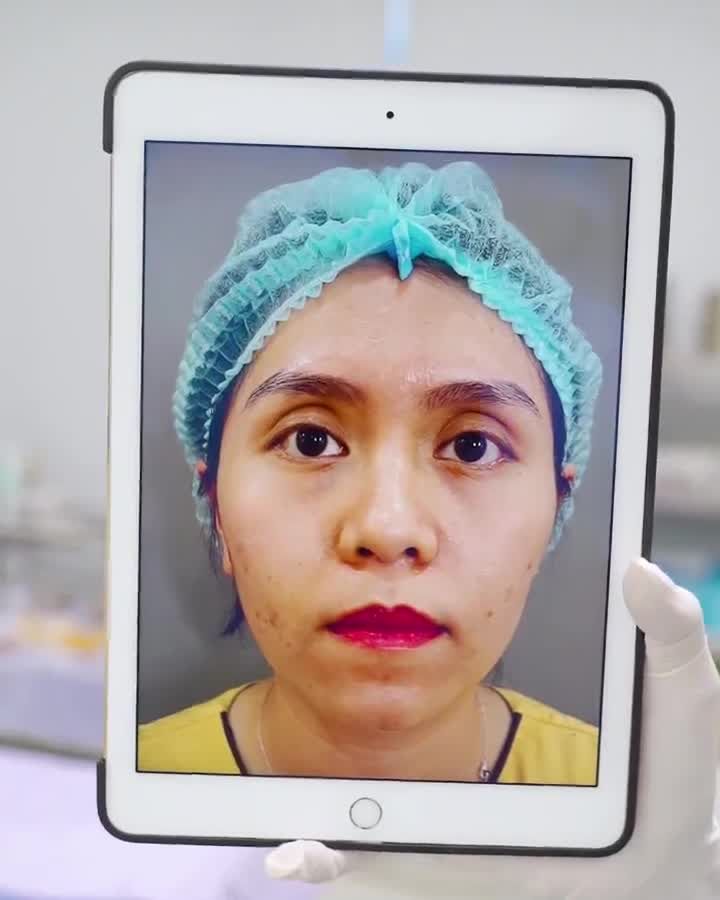 Dr.Hải Lê khắc phục mọi ca mí khuyết điểm từ bệnh lý đến lỗi hỏng nặng