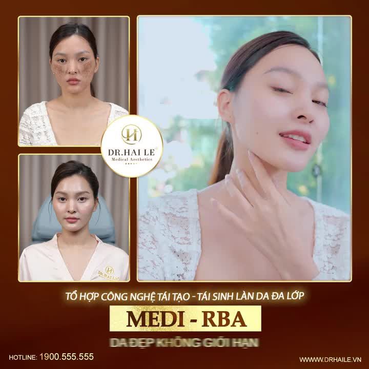 "Chân nám không còn một tí nào. Hết sạch rồi ấy. Mọi người có thể thấy là đi trị nám mà lãi cả làn da căng bóng, trắng sáng như vậy, quá là mê luôn ấy"