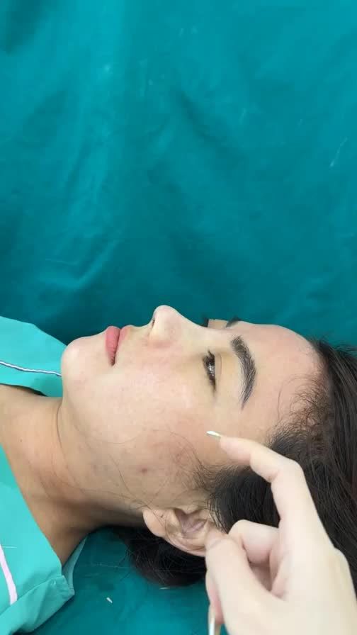 Combo mũi cằm vừa thực hiện xong
