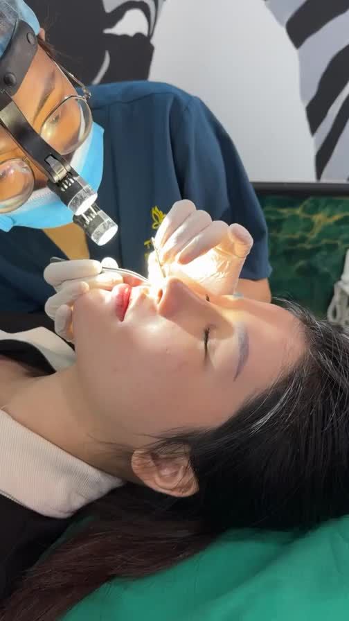 Case mũi bọc sụn được 10 ngày