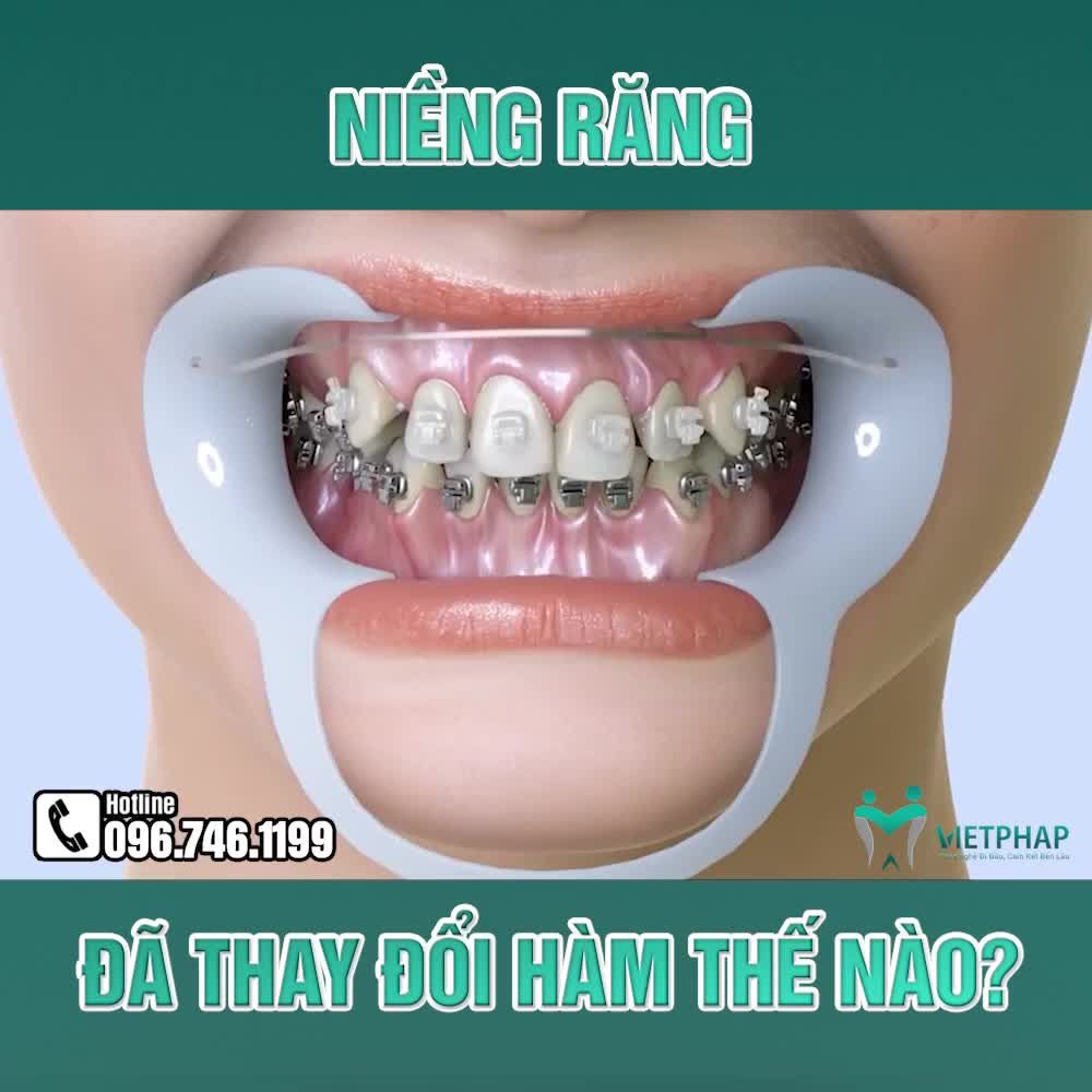 NIỀNG RĂNG THAY ĐỔI HÀM NHƯ THẾ NÀO?