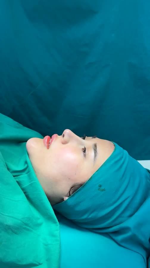 Case mũi cấu trúc vừa hoàn thành
