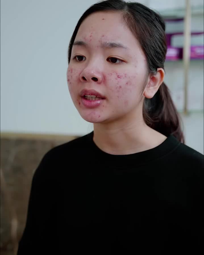 MỤN VIÊM SƯNG/ NỀN DA MỎNG YẾU - PHƯƠNG PHÁP NÀO PHÙ HỢP