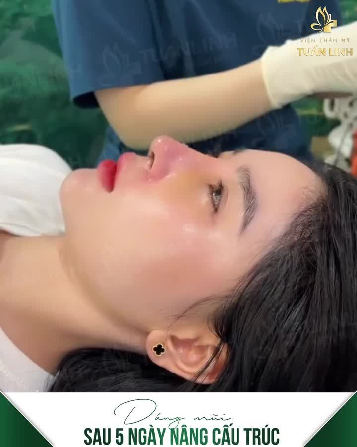 Nâng mũi không sưng bầm, nhanh vào form là như thế nào ạ?