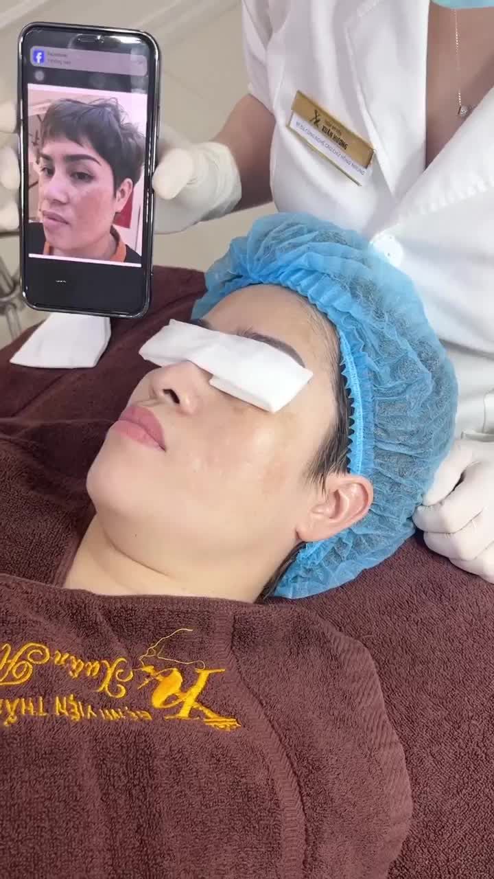 Kết quả sau 1 buổi điều trị nám bằng công nghệ Picosure
