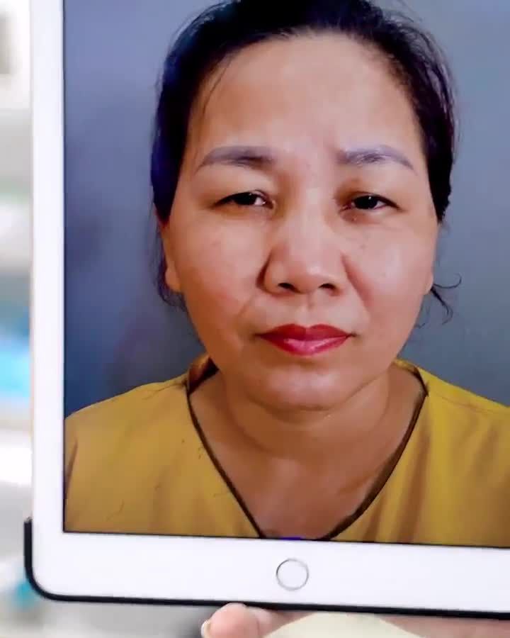 "Hô biến" đôi mắt sụp mí già nua trở nên thanh tú nhẹ nhàng tự nhiên chỉ sau 45 phút đến Dr.Hải Lê