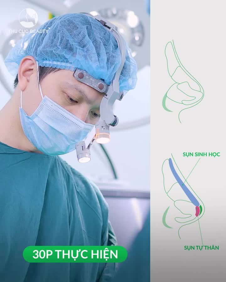 Mũi TC. Xóa sổ sống mũi thấp, cánh mũi to bè chỉ sau 30P 30P thực hiện. An toàn, vô khuẩn chuẩn Bộ Y Tế  05 NGÀY tháo nẹp. Mũi vào form, cao như ý
