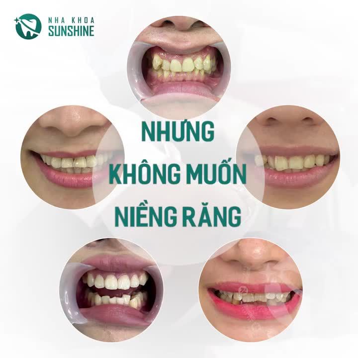 RĂNG KHẤP KHỂNH NHƯNG KHÔNG MUỐN NIỀNG RĂNG VÌ SỢ ĐAU VÀ BẤT TIỆN PHẢI LÀM SAO?