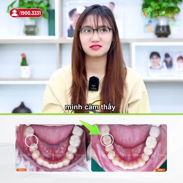 CẤY IMPLANT TẠI VIET SMILE NHANH CHÓNG, KHÔNG ĐAU