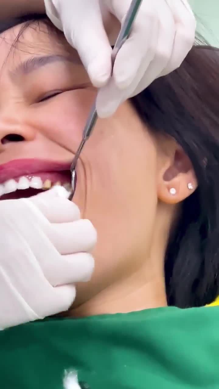 QUÁ TRÌNH THẨM MỸ RĂNG SỨ CHO CHỊ KHÁCH PHÚ THỌ