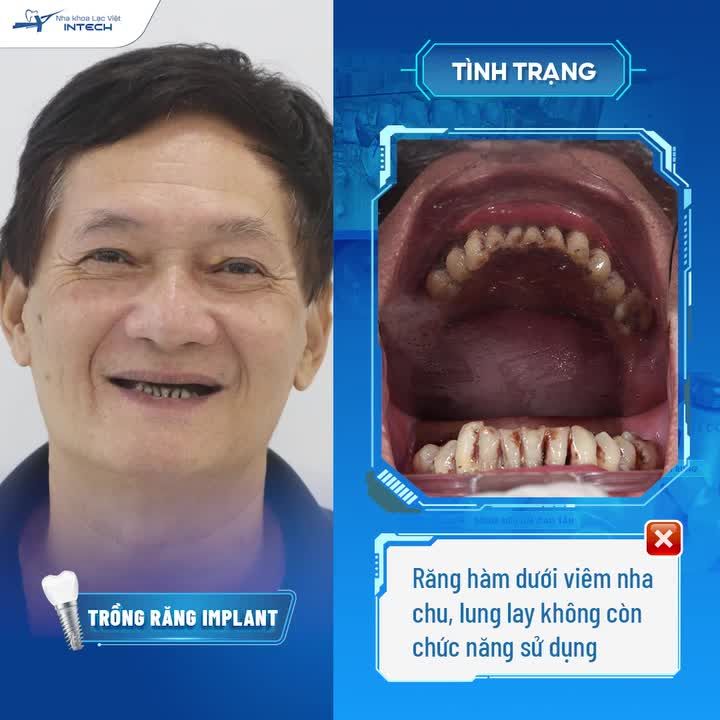 CÁM CẢNH CUỘC SỐNG “ĐÁNH VẬT” VỚI MẤT RĂNG, U70 THAY ĐỔI SAU 3 THÁNG - BẤT NGỜ VÌ CÔNG NGHỆ TRỒNG RĂNG QUÁ HIỆU QUẢ