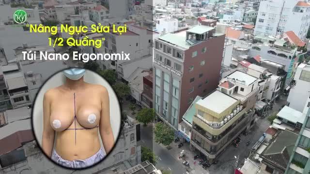 CA NÂNG NGỰC “KHÓ” NHẤT TRONG NĂM
