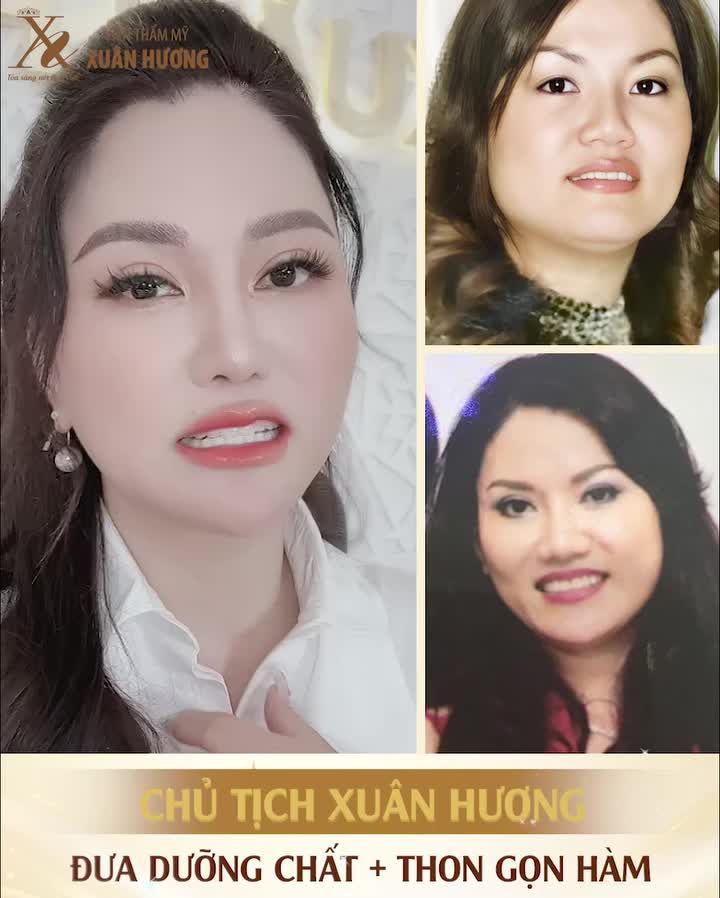 Chủ tịch HĐQT Xuân Hương đã cải thiện đường nét khuôn mặt không cần xâm lấn như thế nào?