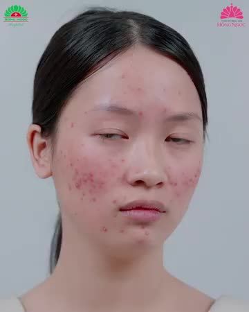 DA SẠCH MỤN - ĐÓN TẾT TỰ TIN