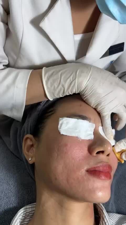 PHƯƠNG PHÁP TIÊM MESO TRONG ĐIỀU TRỊ NÁM CÓ THẬT SỰ CẦN THIẾT?