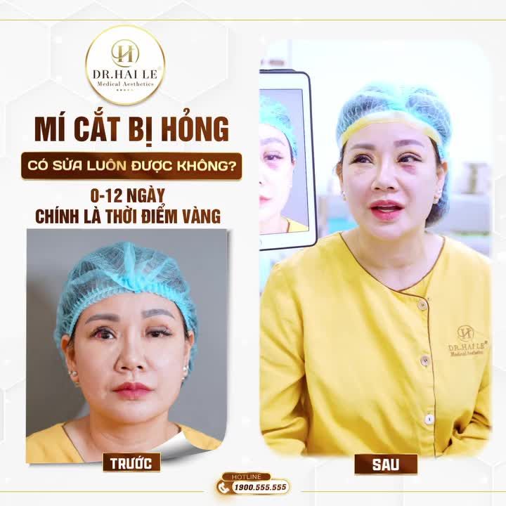 "Từ hôm làm mí bị hỏng, chị lo lắng mất ăn mất ngủ...Sợ quá, không dám gặp ai"