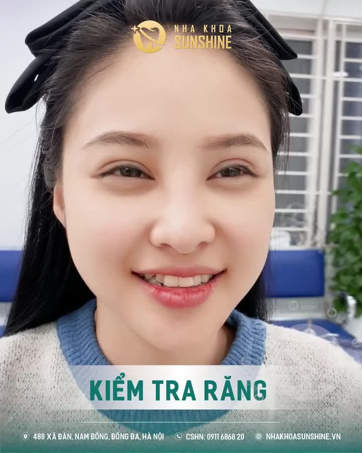 QUY TRÌNH BỌC RĂNG SỨ KHÔNG ĐAU, CHỈ 2 NGÀY HOÀN THIỆN TẠI SUNSHINE