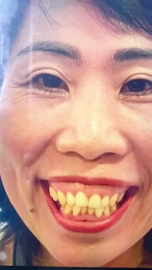 VÀO XEM NGAY: Bác sĩ Tú Dung TẬN TAY phẫu thuật HÀM HÔ cho Quý cô U40 THOÁT KHỎI, MẶC CẢM TỰ TI