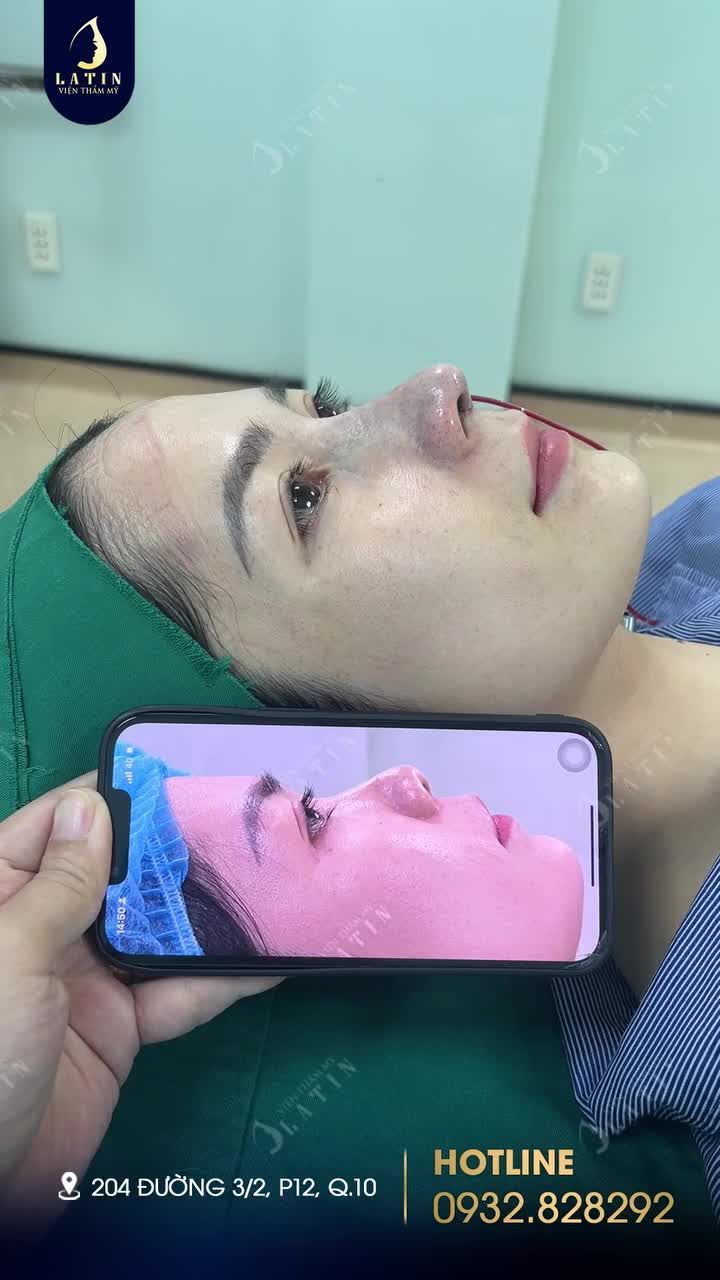 Hoàn thành ca mũi cấu trúc surgiform cho em gái đến từ Kiên Giang