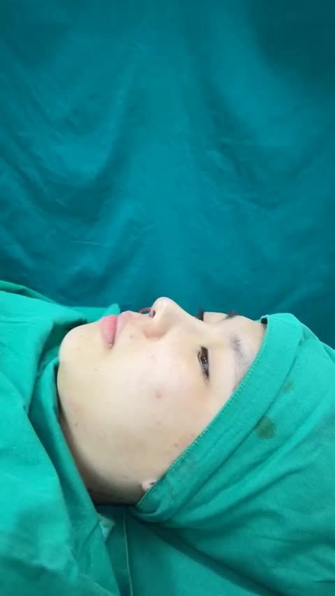 Case mũi cấu trúc vừa hoàn thành