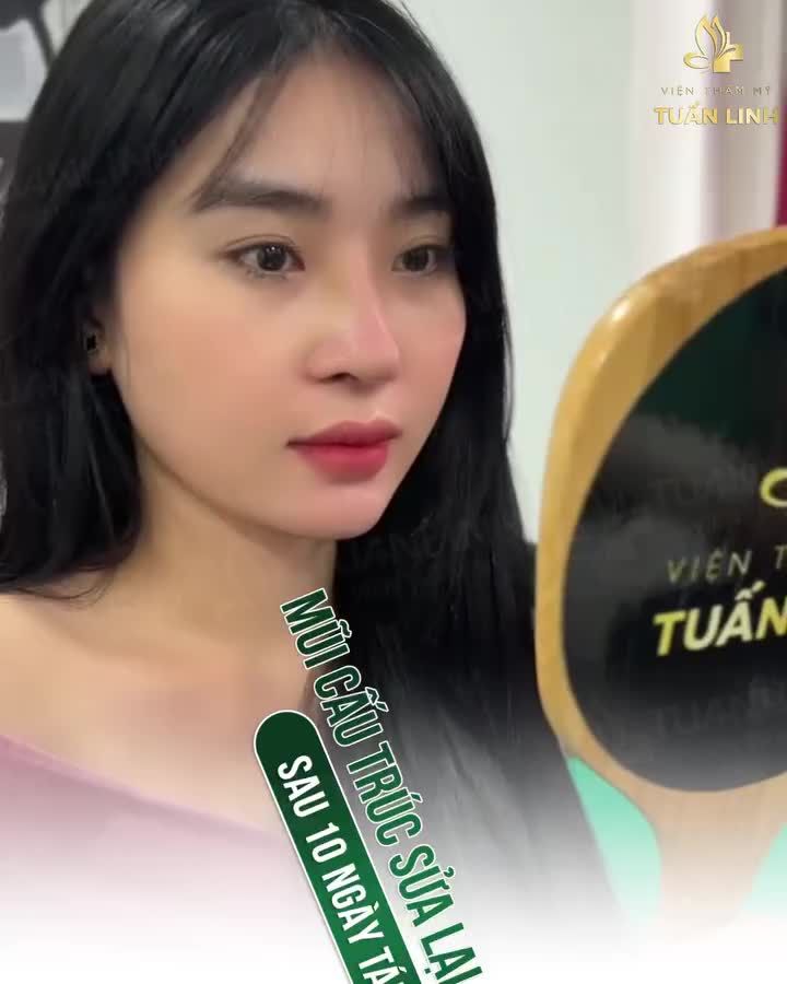 Mũi cấu trúc sau 10 ngày tái khám - Đẹp tự nhiên, trẻ trung, ấn tượng.