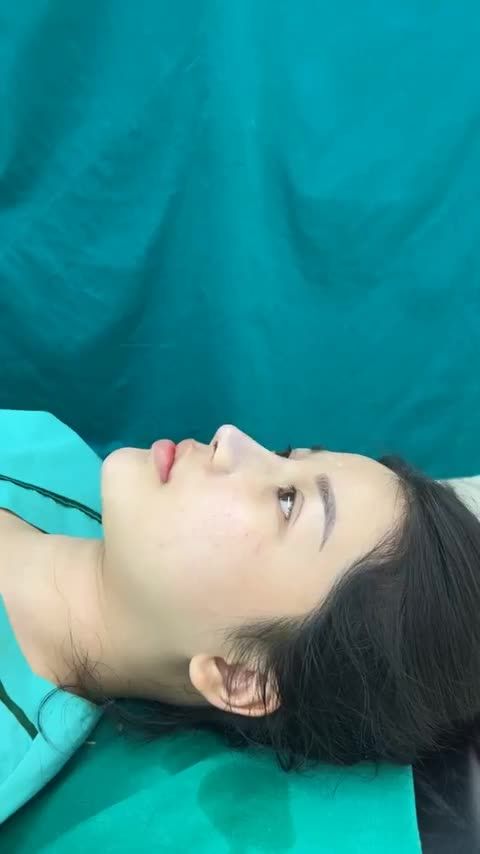 Case mũi bọc sụn vừa hoàn thành  Giá đang giảm nhé các bạn ơi