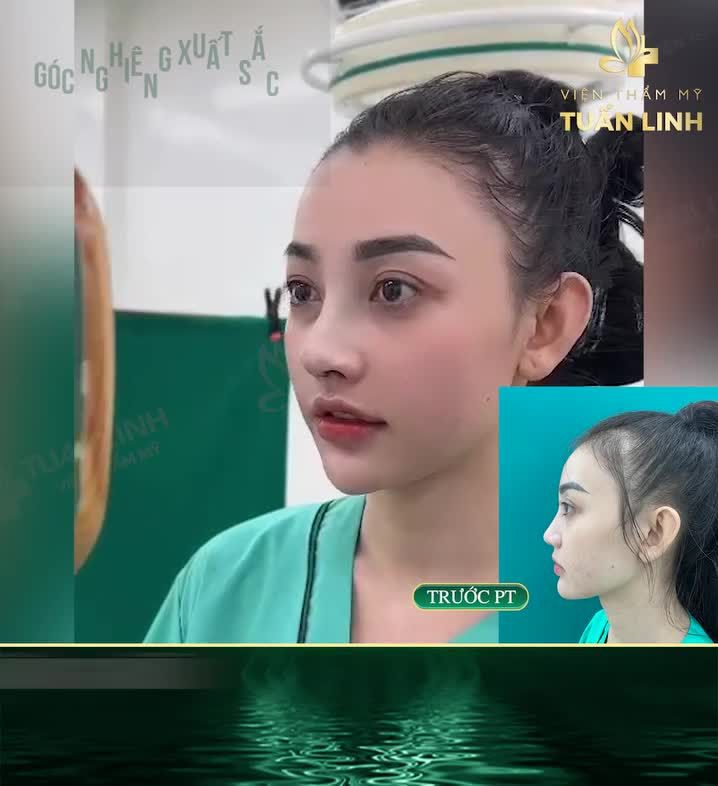 NÂNG MŨI CẤU TRÚC CHỈ 29TR500 - ĐẸP NGAY SAU 90 PHÚT!