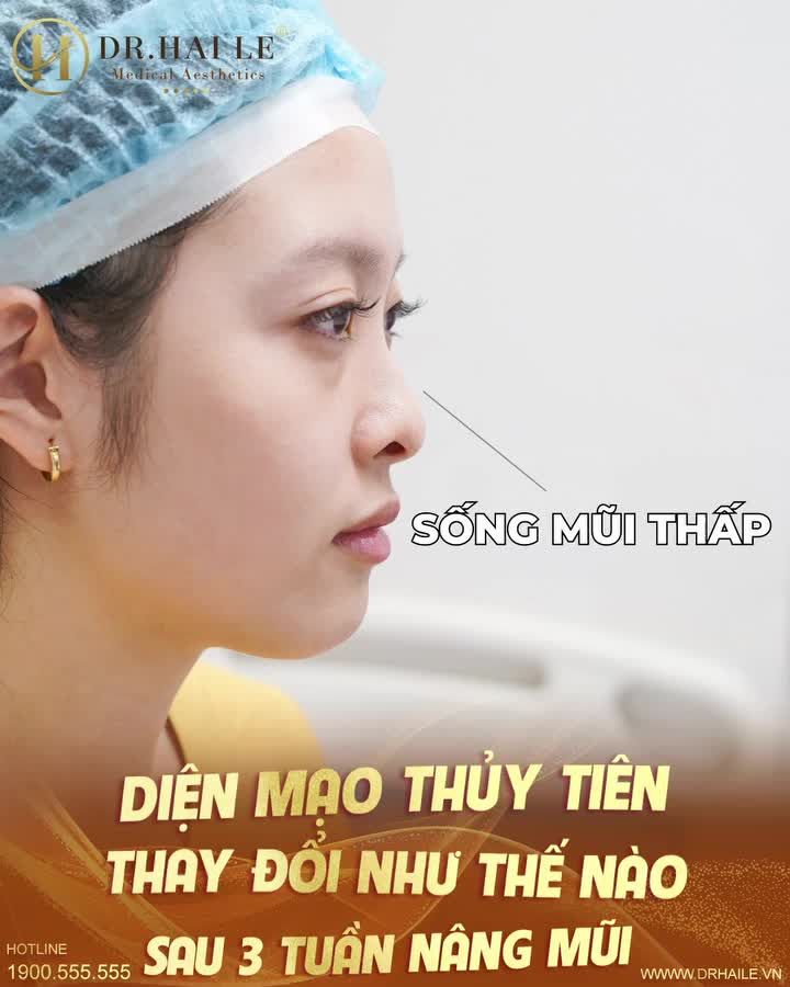 Từ chiếc mũi thấp, đầu mũi thô, k.huyết cánh mũi.