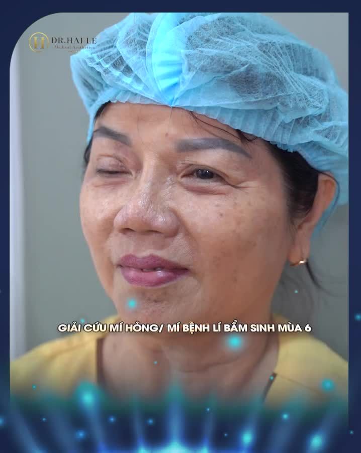 Phẫu thuật Sửa mí/ Chỉnh hình mí bệnh lí bẩm sinh 0 ĐỒNG. BẠN ĐÃ SẴN SÀNG?