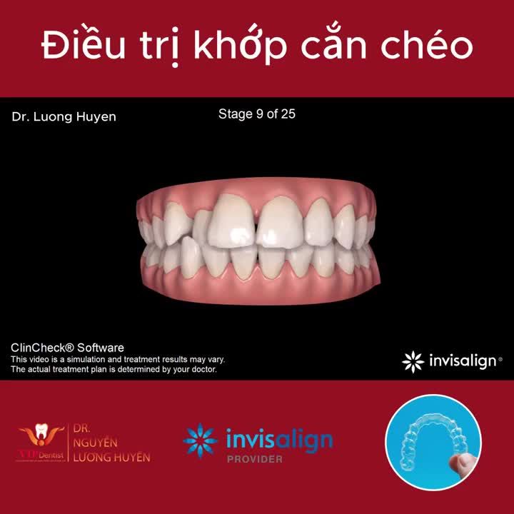 CLINCHECK INVISALIGN - ĐIỀU TRỊ KHỚP CẮN CHÉO