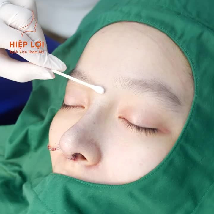 Biến hình chiếc MŨI CẤU TRÚC SỤN SƯỜN TỰ THÂN đón Giáng Sinh