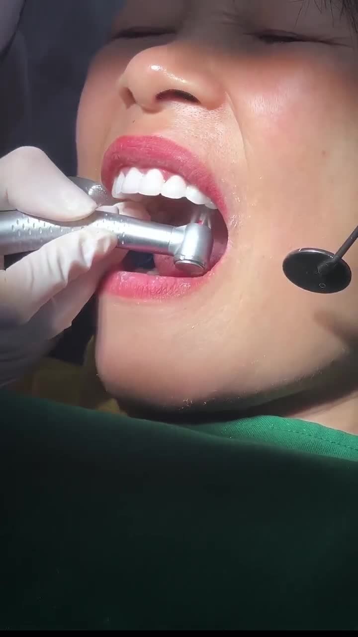 Vậy là quá trình thẩm mỹ răng cho chị Xoan đã đi đến công đoạn cuối cùng. Xem bác sĩ vệ sinh răng miệng và chỉnh khớp cắn cho chị ấy như thế nào nhé!