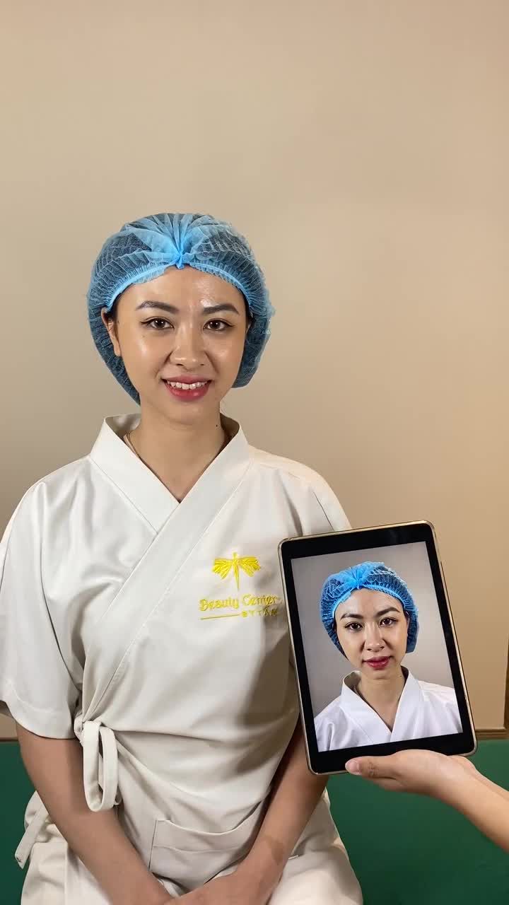 ca FILLER thái dương - cằm buổi sáng đầu tuần thật năng lượng của bạn khách. Khi được tư vấn, bạn mong muốn tiêm dáng thật tự nhiên, tiêm nhưng không ai nhận ra là tiêm và đây là thành quả sau 30 phút thực hiện, chị em xem có đủ tự nhiên chưa nhé!