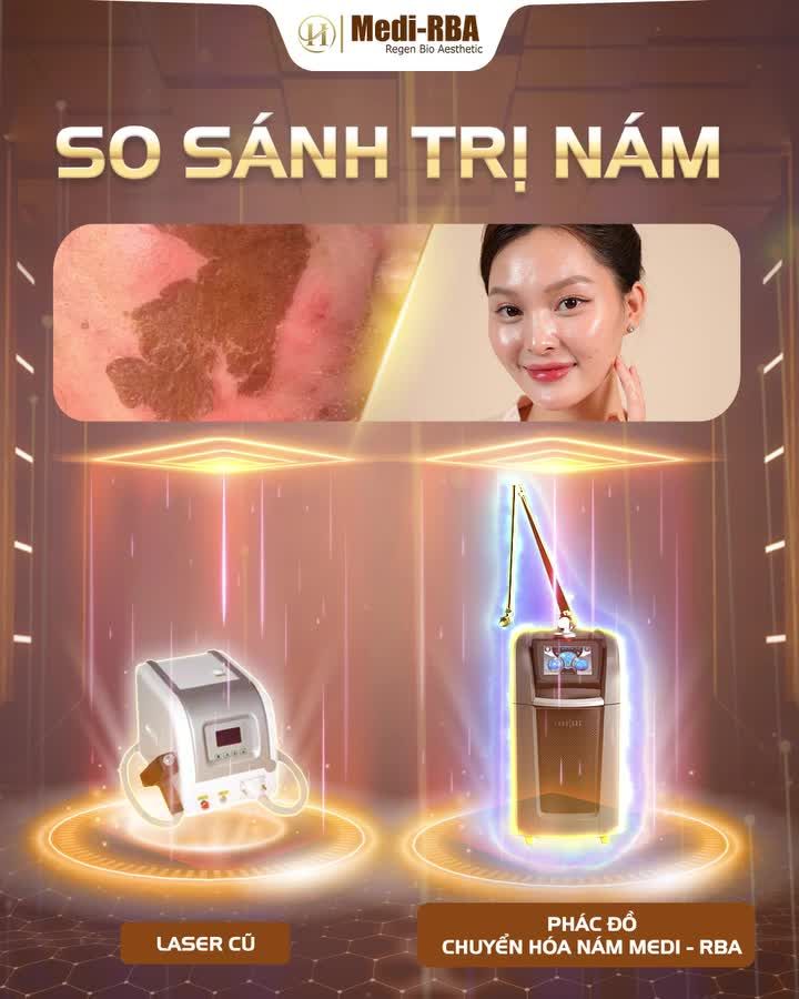 TRỊ NÁM BẰNG LASER CŨ TỐN KÉM/ MẤT THỜI GIAN