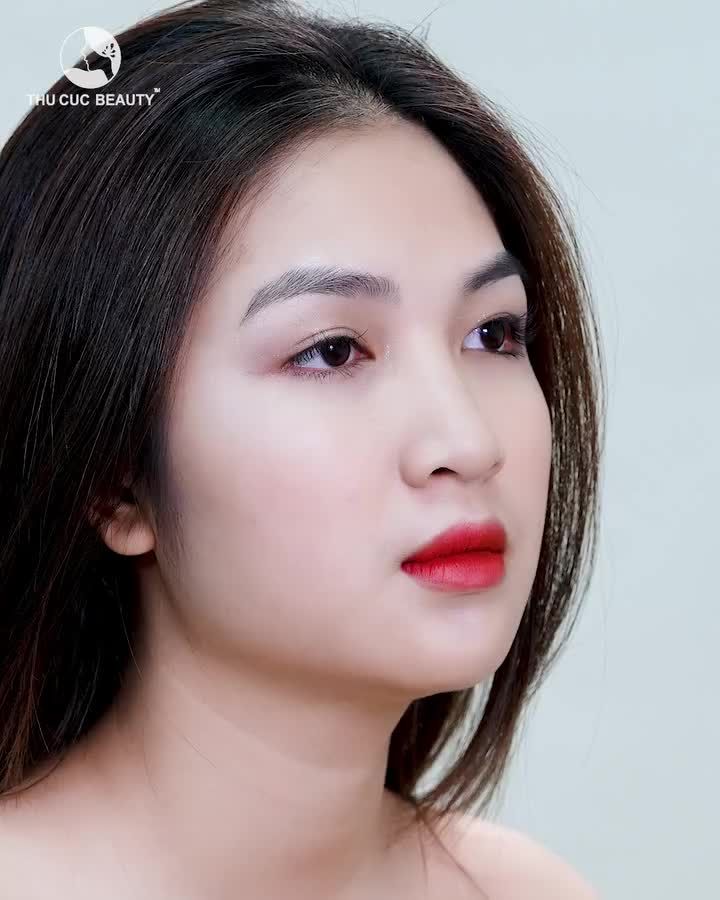 Chỉ 30P tạm biệt ngay sống mũi thấp, đầu mũi to cùng Mũi TC An toàn, vô khuẩn chuẩn Bộ Y Tế  05 NGÀY tháo nẹp. Mũi vào form, cao như ý