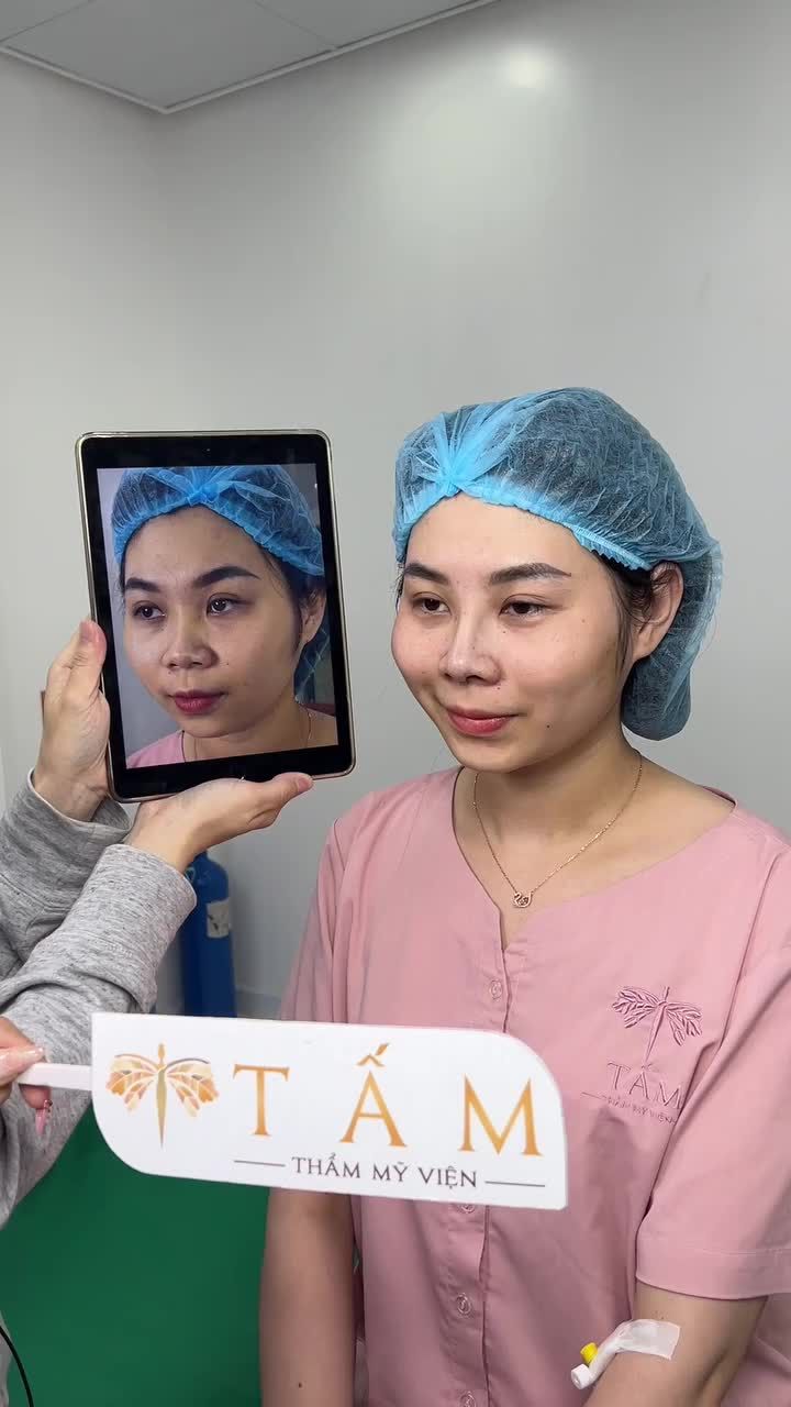 Từng tiêm filler mũi nhưng kết quả chưa ưng ý, chị Thúy An đến với Tấm tìm đến dáng mũi hoàn hảo nhất.